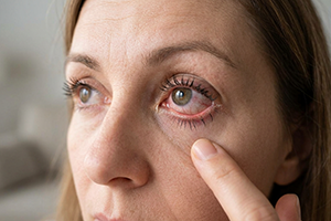 Dry-Eye-Syndrome