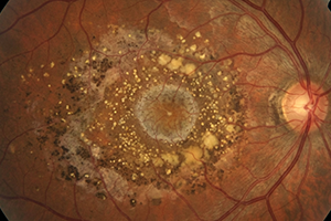 Macular-Degeneration