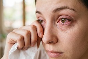 Eye-Allergies