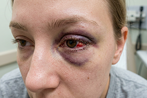 Eye-Emergencies